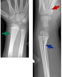 Maybe you would like to learn more about one of these? Emergency Medicine Pearls Pitfalls For Treatment Of Pediatric Distal Radius Fractures Page 4 Of 6 Acep Now Page 4