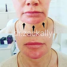 Cost of a chin filler. Chin Filler Derma Models