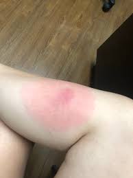 It is caused by allergenic polypeptides in mosquito saliva, and therefore is not contagious. Allergy To Mosquito Bites January 2019 Babies Forums What To Expect