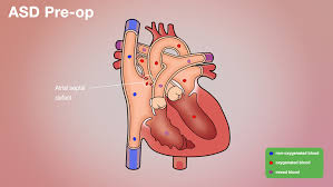Image result for Atrial Septal Defect