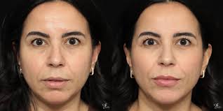 Facial Fillers Chesterfield