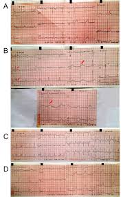 Image result for Early Repolarization