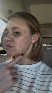 Would you try an advanced corrective chemical peel?, This isn’t your basic  peel — it’s a results-focused treatment designed to correct, renew, and  restore skin at a deeper level. Expect brighter skin, ...