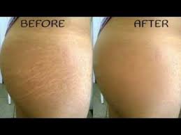 Leg Bio Oil Before And After Scars How To Get Rid Of Stretch Marks Fast This Remedy Works Perfect In Removing Stretch Marks Fast Cocon Stretch Marks Oil Skin Care Routine Bio Oil Stretch Marks