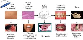 Mouth cancer can make it painful to eat and difficult to swallow, which can cause weight loss. The Dental Management Of A Mouth Cancer Patient British Dental Journal