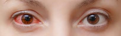 Image result for images Conjunctivitis (Pink Eye)