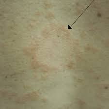 It is not harmful or passed on through touching (contagious). How To Recognize Pityriasis Rosea