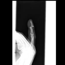 Image result for DIP Dislocation
