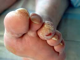 Image result for diabetic toes