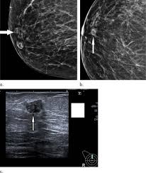 What does breast cancer look like on a mammogram? Digital Mammography Increases Breast Cancer Detection Eurekalert Science News