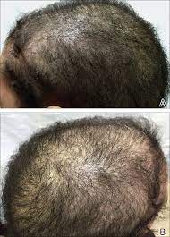 According to research, vitamin b12 deficiency can lead to premature hair greying. Nonscarring Alopecia Associated With Vitamin D Deficiency Mdedge Dermatology