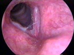 Image result for Acute Laryngitis