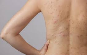 Image result for Deep Folliculitis