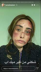 لديك إستفسار او مشكلة؟ نحن هنا للمساعدة. ØµÙˆØ±Ø© ØµØ§Ø¯Ù…Ø© Ù‡Ù†Ø§ Ø§Ù„Ø²Ø§Ù‡Ø¯ Ø¨ÙˆØ¬Ù‡ Ù…Ù…ØªÙ„Ø¦ Ø¨Ø§Ù„Ø¬Ø±ÙˆØ­ ÙˆØ§Ù„ÙƒØ¯Ù…Ø§Øª ÙˆÙƒØ£Ù†Ù‡Ø§ ØªØ¹Ø±Ø¶Øª Ù„Ù„Ø¶Ø±Ø¨ Ø§Ù„Ù…Ø¨Ø±Ø­ Ù…Ø¬Ù„Ø© Ø§Ù„Ø¬Ù…ÙŠÙ„Ø©