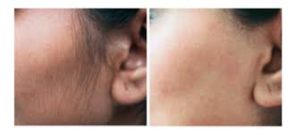 In fact, shaving is highly recommended with this method. Facial Laser Hair Reduction Face Hair Removal Houston Tx Marietta Ga