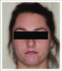 5, 20 euroa kuukausilaskulla, tilillä tai luottokortilla maksettaessa, 8 euroa käteisostoksissa (postiennakko) palautusaika: Hirsutism And Acne On The Chin And Jawline On A Polycystic Ovarian Download Scientific Diagram