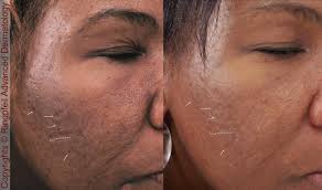 Hyperpigmentation after foamed bleomycin sclerotherapy for vascular malformations. African American And Ethnic Skin Dermatology Black Dermatologist