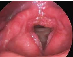 Image result for Acute Laryngitis