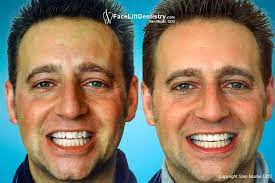 Check spelling or type a new query. Crooked Teeth Straightened With Instant Braces