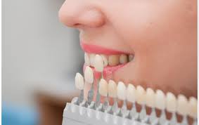 Pretul unei coroane dentare variaza intre 100 si 1200 de euro. Pret Fatete Dentare Dr Leahu Dental Clinics