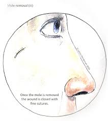 Melanoma is the rarest form of skin cancer, and the only one linked to new or changing moles. Moles And Skin Cancer James Henderson Specialist Plastic Hand Surgeon