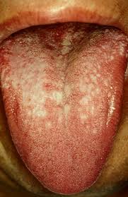 Image result for lichen planus on tongue)