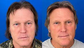 2,000 Graft Hair Transplant Case Study