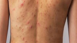 Jerawat di badan termasuk dada, punggung, dan perut tidak bisa diatasi dengan cara yang sama dengan menghilangkan jerawat di wajah. 9 Arti Letak Jerawat Di Tubuh Tunjukkan Masalah Kesehatan Hot Liputan6 Com