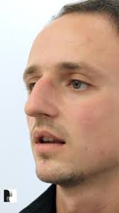 Dr. De Silva's Rhinoplasty Transformation Results! #fyp #rhinoplasty  #drjuliandesilva #harleystreet #transformation