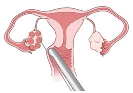 An egg retrieval typically takes place under some form of sedation, so you will not feel any pain. Fertility Preservation Options For Females Starting Cancer Treatment Memorial Sloan Kettering Cancer Center