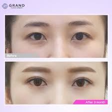 Double Eyelid Surgery Natural Adhesion Method Full Incision Method Double Eyelid Surgery Grand Plastic Sur Eyelid Surgery Double Eyelid Best Eyebrow Products
