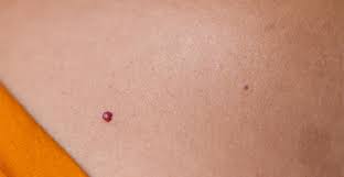 5 medical treatment for cherry angiomas. Cherry Angiomas Skin And Laser Center Of Nj