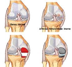 La mobilité devient de plus en plus difficile. La Prothese Du Genou Prothese Unicompartimentale Et Prothese Totale
