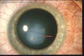 Herpes simplex virus (hsv) is associated with a variety of ocular diseases, including epithelial and stromal keratitis. Pin On Eye Dots Spots Lines