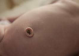 While the stump is drying up and just after it falls off, you might notice some oozing around baby's belly button. Will Your Baby Have An Innie Or An Outie New Parent
