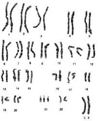 Autosome, chromosomal disorder, chromosome student exploration: 2