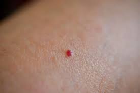 Angiome rubis, centre laser, esthetic, esthetique, film, fotona, ipad, iphone, laser, peau, r33, rouge, vaisseaux, video, yag. Faut Il S Inquieter Au Sujet Des Petites Taches Rouges Qui Apparaissent Parfois Sur La Peau