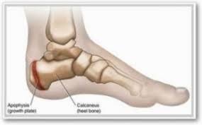 Image result for Calcaneal Apophysitis