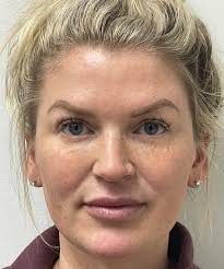 Best PDO Thread Lift In Orlando