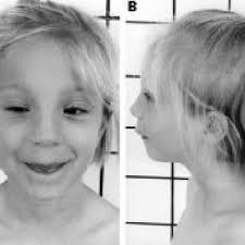 The clinical characteristics of Nijmegen breakage syndrome and their...