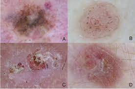 Some types of skin cancer are more dangerous than others, but if you have a spot. Classic Dermoscopy Improves The Early Diagnosis Of Melanoma And Download Scientific Diagram