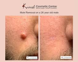 The Top Benefits of Non-Surgical Mole Removal in Chicago | Scarless Laser Mole  Removal Treatments