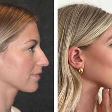 NEW YORK CENTER FOR FACIAL PLASTIC SURGERY