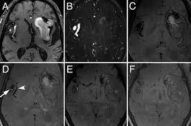 Aneurysm segmentation in mri images in. Conventional And High Resolution Vessel Wall Mri Of Intracranial Aneurysms Current Concepts And New Horizons In Journal Of Neurosurgery Volume 128 Issue 4 2018