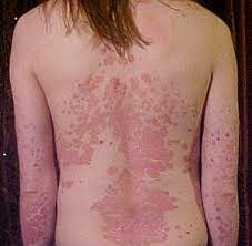 Psoriasis Wikipedia