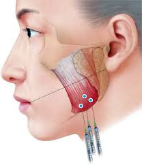 Image result for Botulinum Toxin Injection