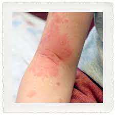 For example, you may develop a rash on your arm when you wear a shirt that was washed with a particular detergent or treated with a chemical. Localized Rashes Trailhead Pediatrics