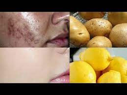 Sivilce Izleri Nasil Giderilir Dogal Leke Giderici Patates Limon Maskesi Tum Ciltler Icin Youtube Sivilce Izi Dogal Cilt Bakimi Dogal Cilt
