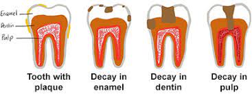 Understanding And Preventing Cavities - American Dental Association