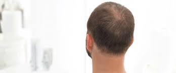 Was Tun Bei Kreisrundem Haarausfall Ducray